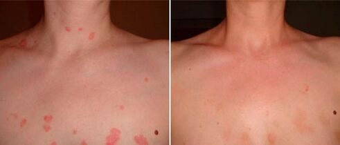 Psoriasis before and after treatment with Keramin cream