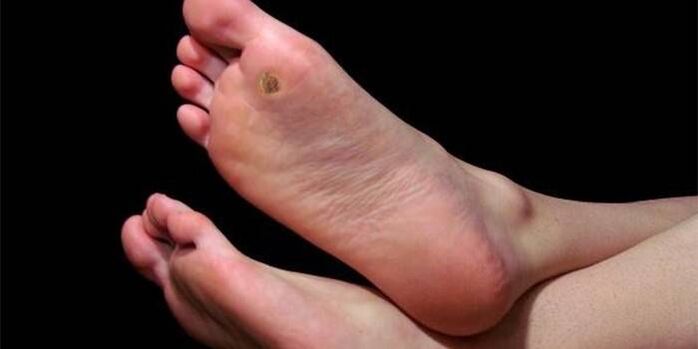 Plantar (tip) wart on the foot