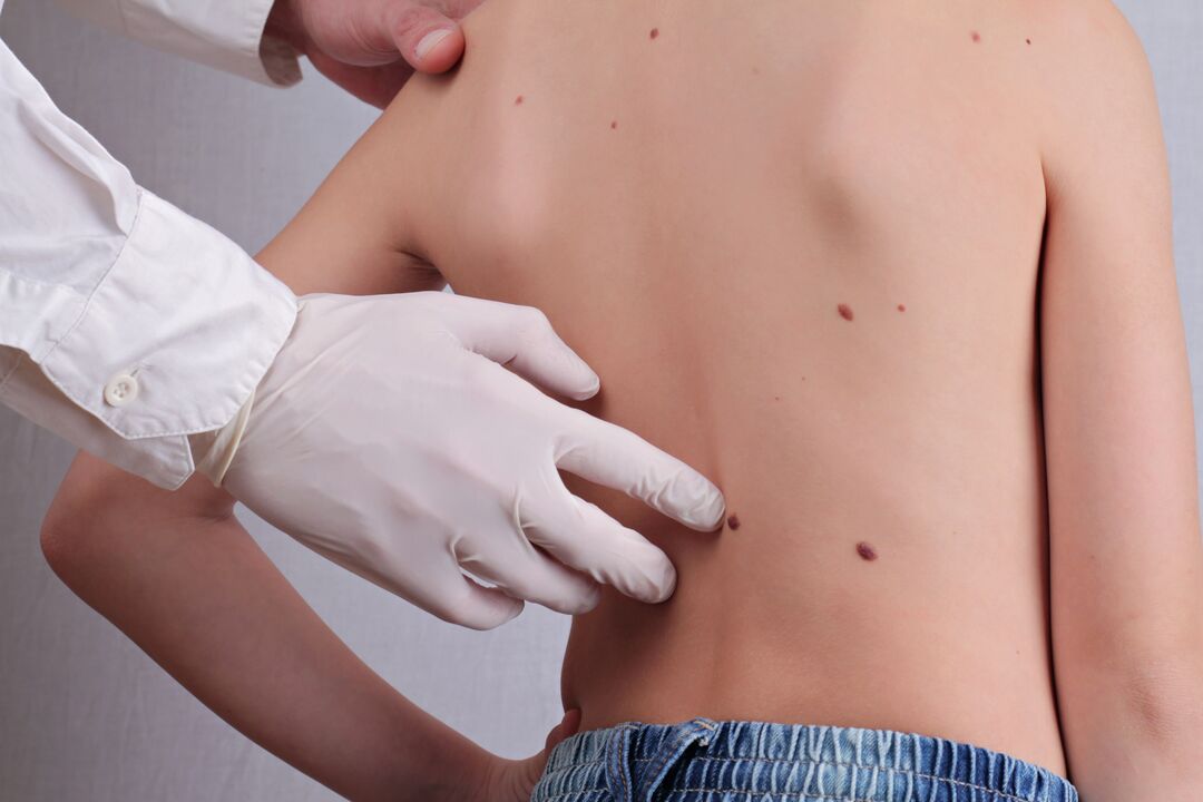 A dermatologist conducts a clinical examination of a patient with papillomas on the body