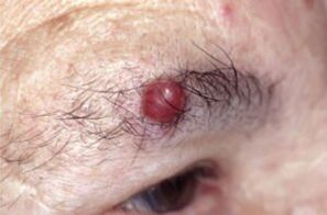 Papilloma on eyebrows