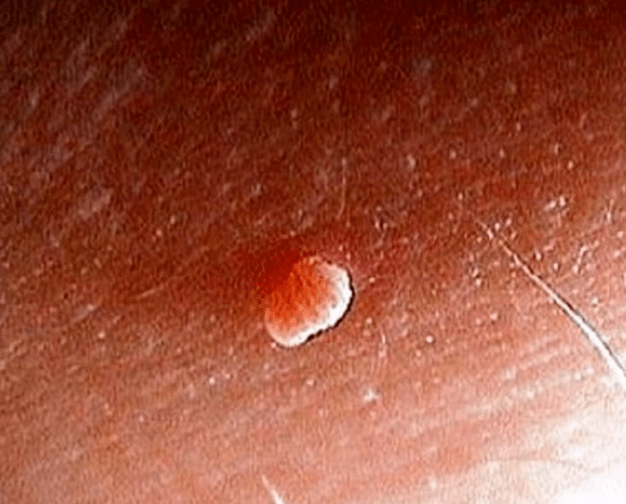Body papilloma