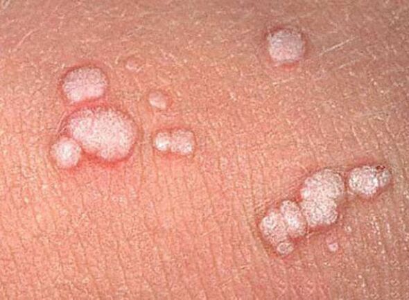 Papillomas on the human body