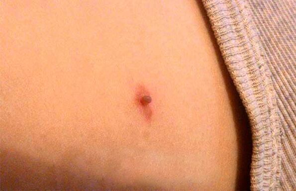 papilloma