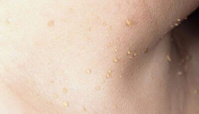 risk of developing papillomatosis in the neck