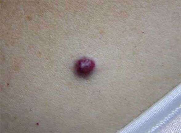 red mole on body