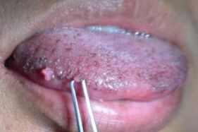 Papillomas on the tongue
