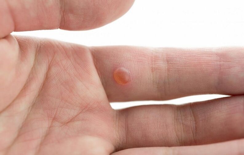 common wart on the finger
