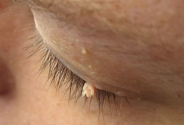filamentous wart on the eyelid