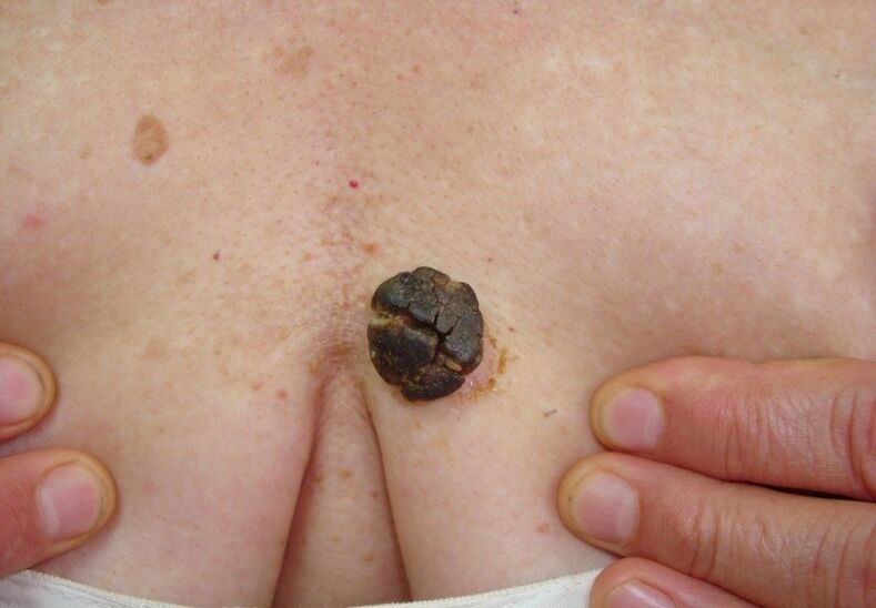 keratoma on human body