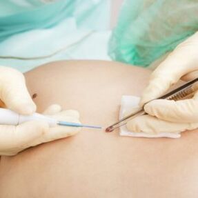 removal of papilloma by a surgeon