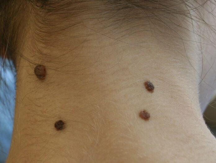 what do papillomas look like on the neck