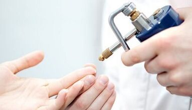 Cryodestruction as a method of treatment of warts