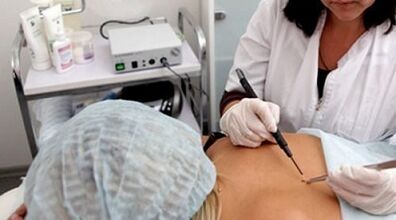 Electrocoagulation as a method of eliminating warts