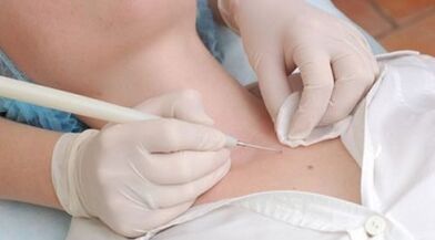 Elimination of laser from warts